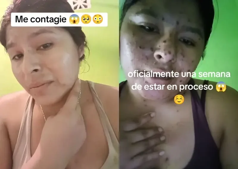 Mujer asegura que se contagió de viruela, pero era varicela