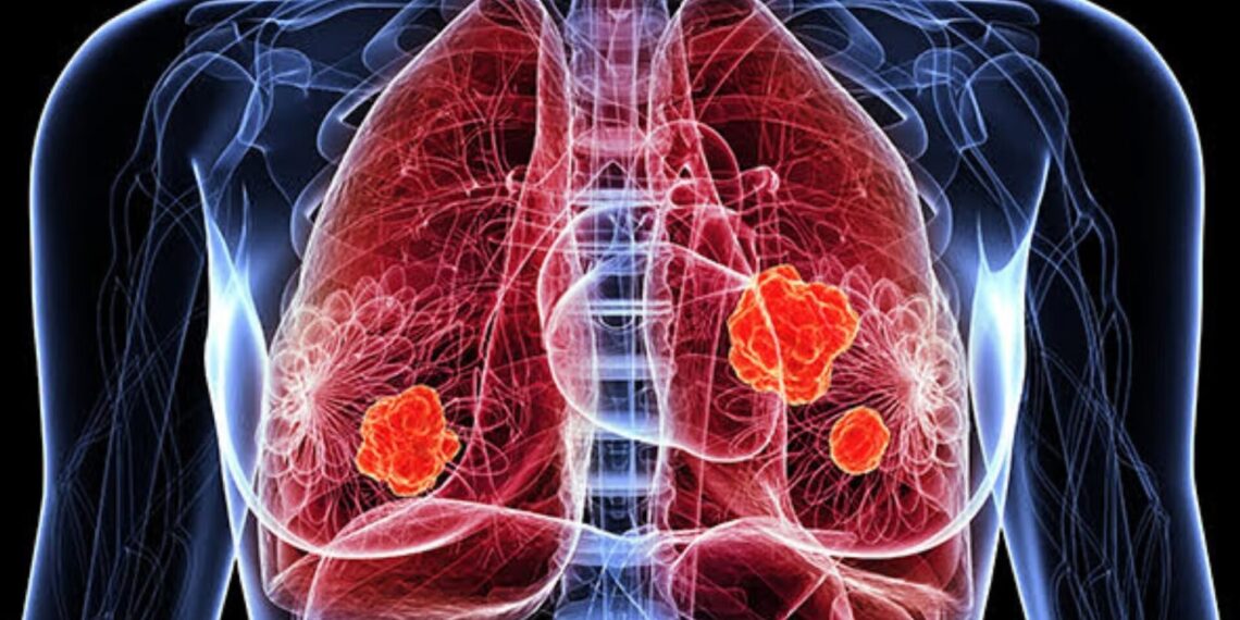 OMS alerta sobre medicamento falsificado para tratar el cáncer de pulmón no microcítico