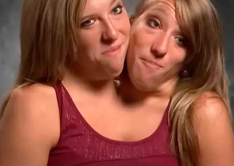 Famosas mellizas Hensel que comparten cuerpo, desatan rumores de embarazo