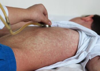 México emite nuevo aviso epidemiológico por sarampión; alerta casos importados