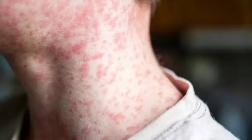 Salud registra 48 muertes de menores de un año por tosferina y 583 casos de sarampión