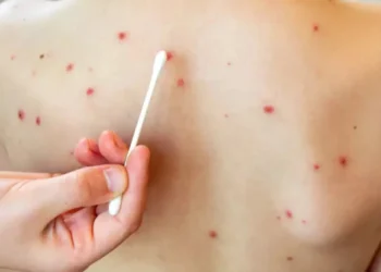 México registra 362 casos de sarampión, la mayoría en Chihuahua