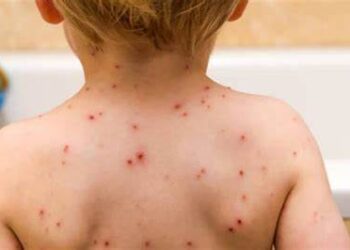 Alerta en EE.UU.: Brote de sarampión deja tres muertos y más de mil casos