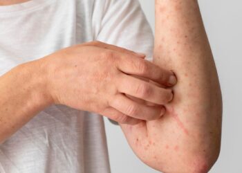 Salud confirma mil 926 casos de sarampión en México