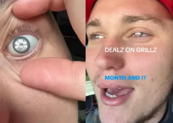 Joven recibe duras críticas tras implantarse un diamante en el ojo; pero la razón es conmovedora