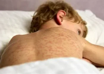 Confirman 10 casos de sarampión en Sinaloa; todos son importados