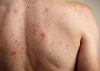 México es el segundo país con más muertes por sarampión a nivel mundial en 2025, advierte la OPS