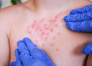 Secretaría de Salud refuerza llamado a la vacunación ante brote de sarampión en México