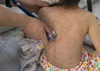 Sube a 31 fallecimientos por sarampión en México; van 9 mil 850 contagios