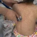 Sube a 31 fallecimientos por sarampión en México; van 9 mil 850 contagios
