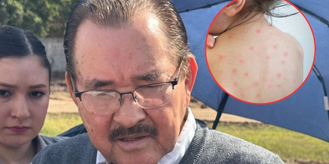 Reportan doce casos de sarampión en Sinaloa: piden reforzar la vacunación