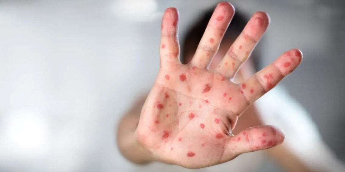 Suman 32 muertes por sarampión; ¿qué estados reportan más casos?