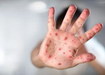 Suman 32 muertes por sarampión; ¿qué estados reportan más casos?