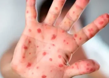 Casos de sarampión en México durante 2026 ya superan el total del año pasado